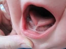Dính lưỡi - nguyên nhân gây ảnh hưởng đến phát âm của trẻ - Ảnh 3.