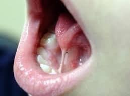 Dính lưỡi - nguyên nhân gây ảnh hưởng đến phát âm của trẻ - Ảnh 2.