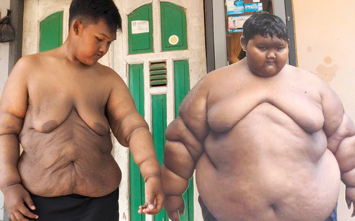 Hành trình giảm cân ngoạn mục của cậu bé béo nhất thế giới nặng gần 200kg khi mới 10 tuổi nhưng để lại cơ thể bị chảy xệ gây ám ảnh