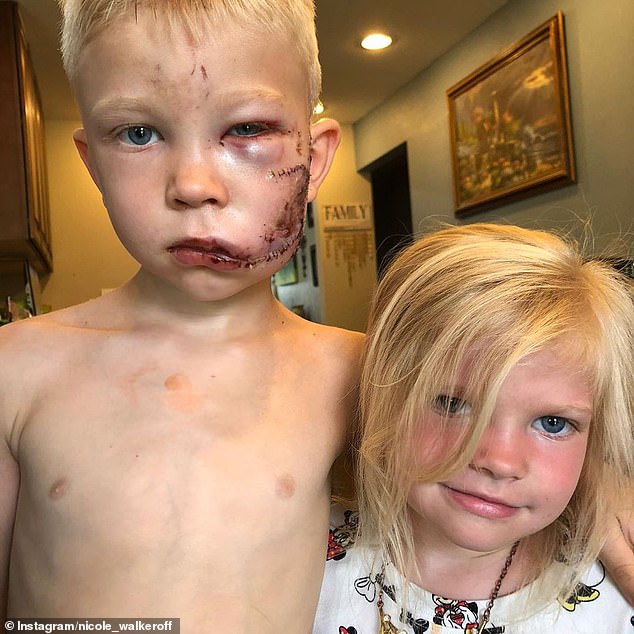Bé trai 6 tuổi bị chó cắn phải khâu 90 mũi trong khi cố bảo vệ em gái, xúc động nhất là câu nói của bé khi mọi người hỏi vì sao lại hành động như thế - Ảnh 1.