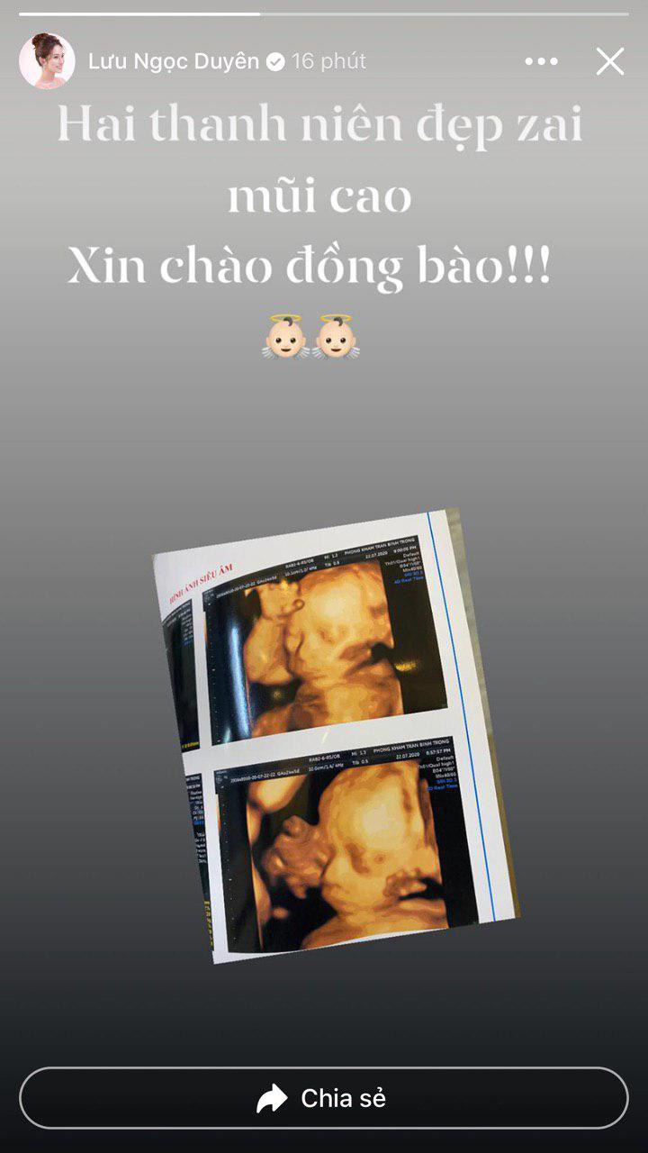 Bà xã Dương Khắc Linh khoe ảnh siêu âm 2 nhóc tỳ, chưa chào đời đã được mẹ dự đoán đẹp trai nhờ đặc điểm nổi trội - Ảnh 1.