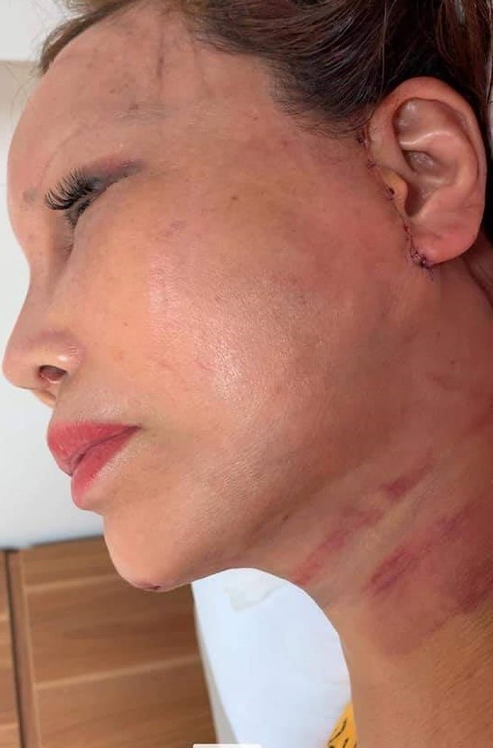 Bủn rủn xem vết sẹo chạy dài dọc phần tai của cô dâu 63 tuổi ở Cao Bằng sau 1 tháng phẫu thuật căng da mặt - Ảnh 2.