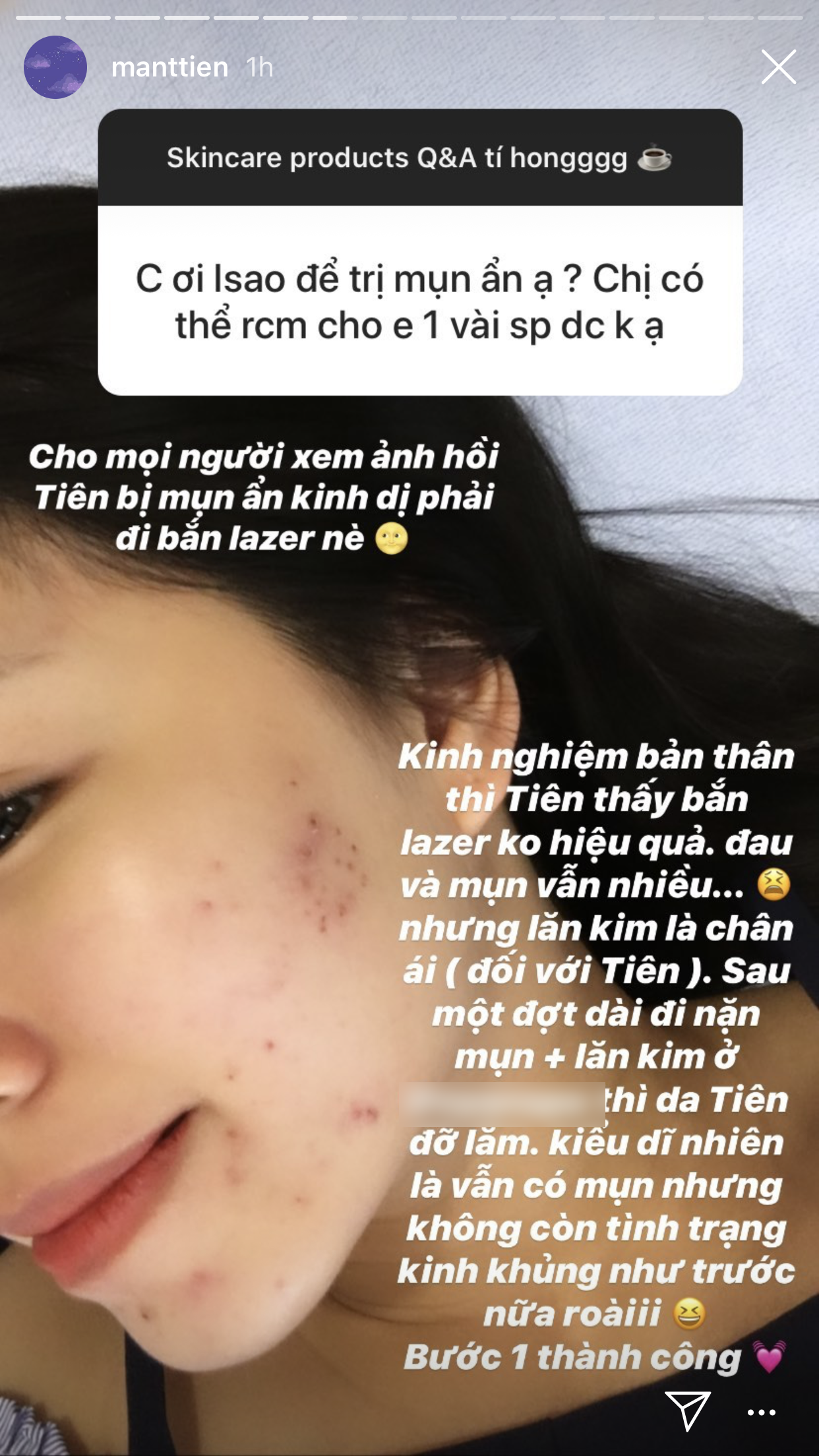 Trước khi da đẹp mĩ mãn, Mẫn Tiên cũng từng khủng hoảng vì mụn ẩn, bon chen bắn laser nhưng kết quả vẫn bằng 0 - Ảnh 2.