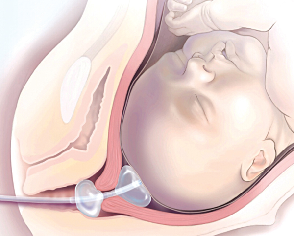Mẹ Hà Nội chia sẻ kinh nghiệm đặt bóng giúp chuyển dạ nhanh khi sinh ở Bệnh viện Thanh Nhàn - Ảnh 1. Mẹ Hà Nội chia sẻ kinh nghiệm đặt bóng giúp chuyển dạ nhanh khi sinh ở Bệnh viện Thanh Nhàn - Ảnh 1.