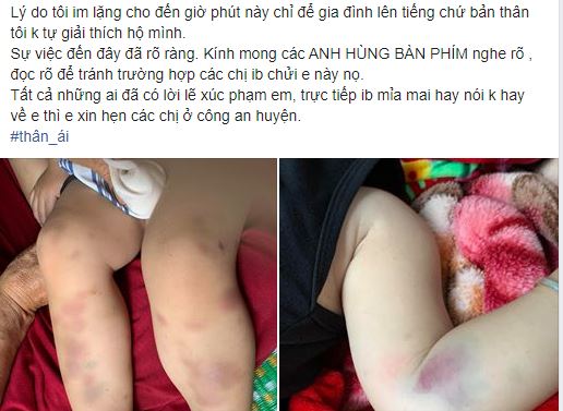 Con trai đi học 2 buổi phát hiện toàn thân bị bầm tím, mẹ bức xúc đăng hình tố cáo lên mạng nhưng sự thật bất ngờ sau đó phụ huynh nào cũng cần chú ý - Ảnh 2. Con trai đi học 2 buổi phát hiện toàn thân bị bầm tím, mẹ bức xúc đăng hình tố cáo lên mạng nhưng sự thật bất ngờ sau đó phụ huynh nào cũng cần chú ý - Ảnh 2.
