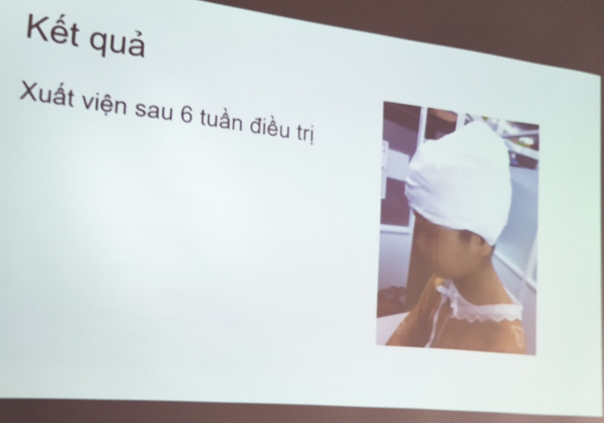 Tóc cuốn vào máy cưa đá, bé gái bị lột hơn một nửa da đầu - Ảnh 2.