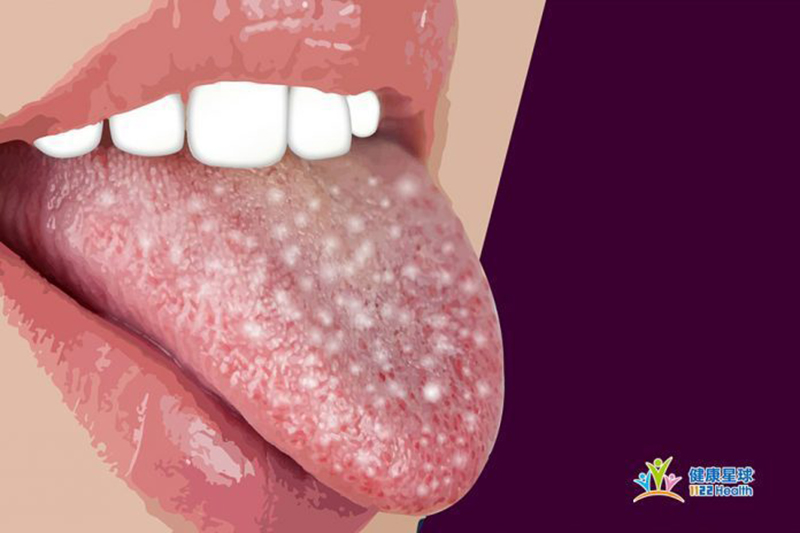 Người trẻ tuổi hiện đại thường không thể sống thiếu cà phê, nhưng nếu thấy dấu hiệu này xuất hiện ở lưỡi thì cần phải hạn chế lại ngay - Ảnh 3.