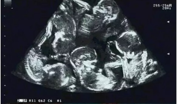 Mừng rỡ khi biết mình mang thai đôi, nhưng đến tháng thứ 5, bà mẹ &quot;chết sững&quot; khi nhìn vào màn hình siêu âm - Ảnh 1.