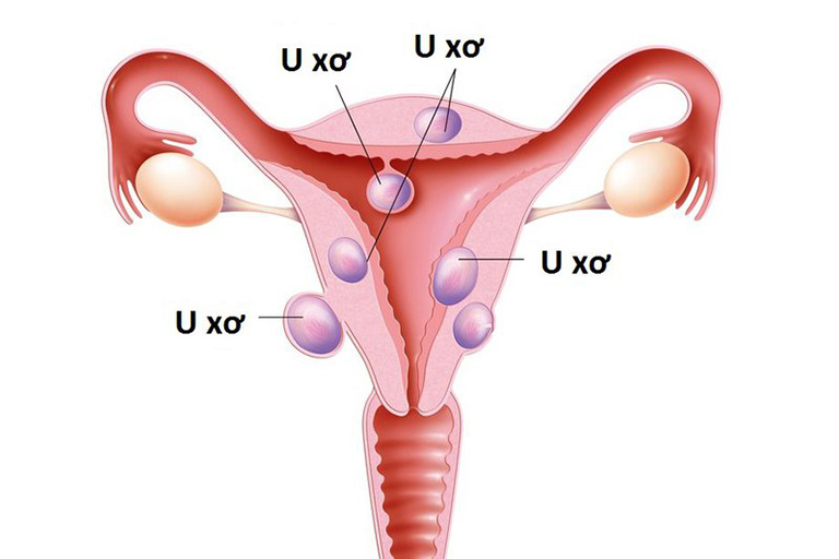 27 tuổi bị 121 khối u xơ tử cung chỉ trong hai năm: Dùng mỹ phẩm tùy tiện hay ăn uống sai? - Ảnh 1.