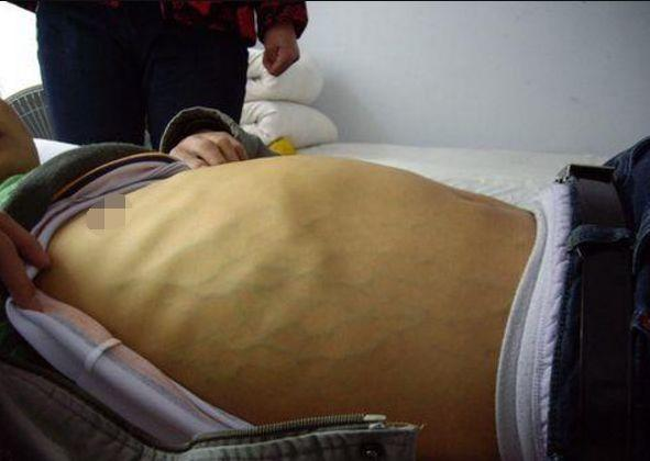 Người đàn ông 33 tuổi bị vàng da toàn thân, bác sĩ kết luận ung thư gan và chỉ ra nếu thường xuyên ăn 5 loại đồ ăn này sẽ không thể có một lá gan khỏe mạnh - Ảnh 1.