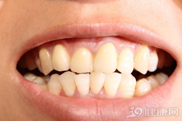 Đại học Harvard công bố kết quả nghiên cứu 20 năm về mối liên hệ giữa răng miệng và ung thư: Người có hàm răng xấu tăng nguy cơ mắc 2 bệnh ung thư - Ảnh 3.