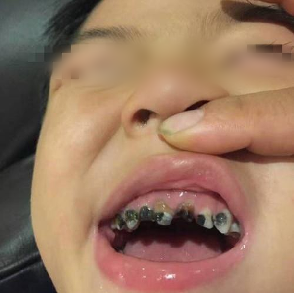 Mới 3 tuổi mà cả hàm răng đã đen sì, nguyên nhân không phải ăn nhiều đồ ngọt, bác sĩ chỉ đích danh sai lầm của cha mẹ. - Ảnh 1.