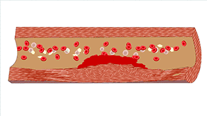 8 bức ảnh động tiết lộ toàn bộ quá trình tắc nghẽn mạch máu, có thể dẫn đến các bệnh lý gây tử vong - Ảnh 8.