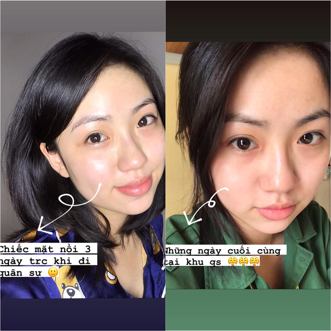 Nổi mụn ẩn sần khắp trán, nàng sinh viên vẫn trị khỏi thành công nhờ toàn đồ skincare giá rẻ - Ảnh 1. Nổi mụn ẩn sần khắp trán, nàng sinh viên vẫn trị khỏi thành công nhờ toàn đồ skincare giá rẻ - Ảnh 1.