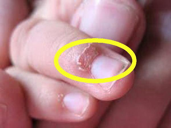 Bé trai 5 tuổi phải tháo móng tay vì nhiễm trùng, 3 thói quen xấu ở trẻ cần phải loại bỏ - Ảnh 1. Bé trai 5 tuổi phải tháo móng tay vì nhiễm trùng, 3 thói quen xấu ở trẻ cần phải loại bỏ - Ảnh 1.