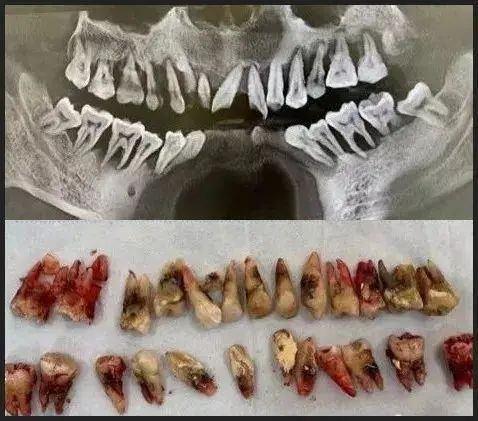 Người đàn ông 31 tuổi đi khám vì răng lung lay, nhưng bác sĩ lại nhổ tất cả răng vì sai lầm từ 2 năm trước của anh - Ảnh 1.