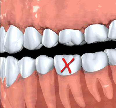 Người đàn ông 31 tuổi đi khám vì răng lung lay, nhưng bác sĩ lại nhổ tất cả răng vì sai lầm từ 2 năm trước của anh - Ảnh 5.