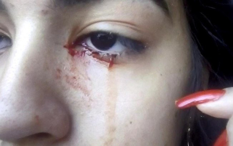 Ca bệnh lạ tại Brazil: thiếu nữ liên tục khóc ra...máu - Ảnh 1.