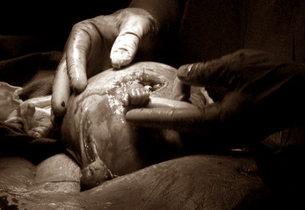 20 năm sau khoảnh khắc ấn tượng, thai nhi 21 tuần tuổi trong bức ảnh thò tay ra khỏi tử cung mẹ nắm chặt ngón tay bác sĩ gây chấn động thế giới giờ ra sao? - Ảnh 1.