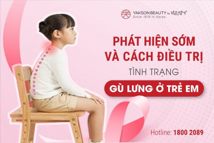 Nhận biết tình trạng gù lưng ở trẻ và cách khắc phục - Ảnh 1.