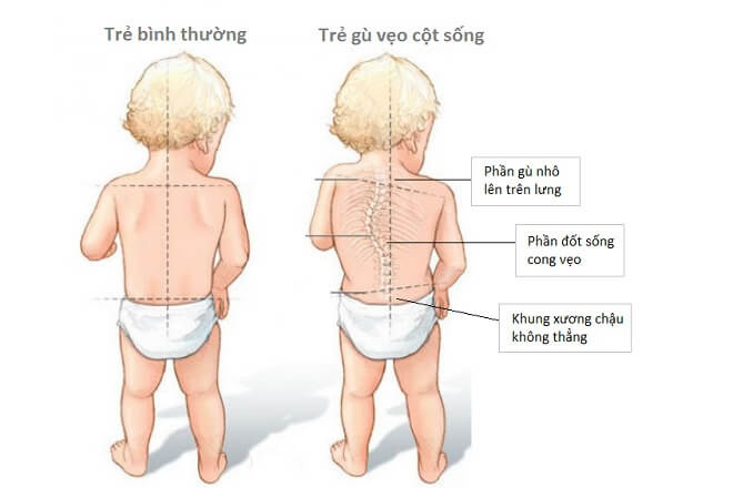 Nhận biết tình trạng gù lưng ở trẻ và cách khắc phục - Ảnh 3.