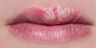 Cảnh báo nhiễm herpes khi xăm môi - Ảnh 2. Cảnh báo nhiễm herpes khi xăm môi - Ảnh 2.