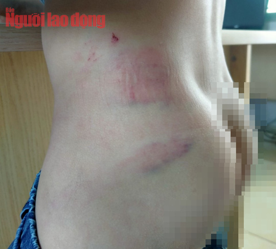 B&eacute; 9 tuổi nghi bị cha bạo h&agrave;nh d&atilde; man - Ảnh 3.