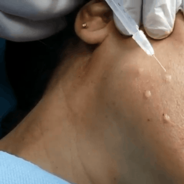 Phương pháp tiêm nghìn lỗ trên mặt: - Ảnh 3. Phương pháp tiêm nghìn lỗ trên mặt: - Ảnh 3.