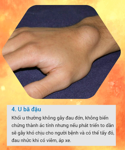 BS khuyến cáo về các loại u vùng cổ tay hay gặp: Đừng bỏ qua vì đó có thể là dấu hiệu cảnh báo bệnh nguy hiểm - Ảnh 4.