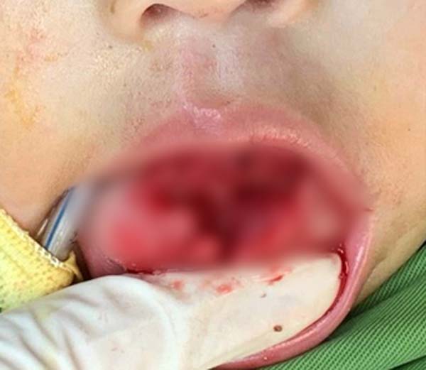 Bé 1 tuổi bị tai nạn rách lưỡi, nguyên nhân trẻ nào cũng dễ gặp phải - Ảnh 1. Trẻ một tuổi bị tai nạn rách lưỡi từ nguyên nhân bố mẹ nào chủ quan - Ảnh 1.