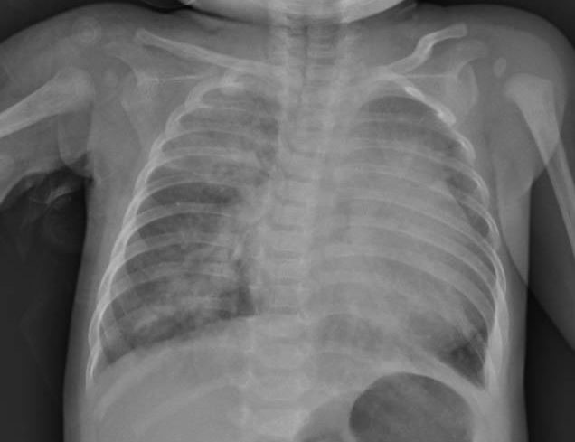 Hành trình chiến đấu Covid-19 của bé mắc tim bẩm sinh giữa tâm dịch TP HCM: Rưng rưng khi cô bé 3 tháng tuổi nguy kịch, khó thở, môi tím tái - Ảnh 2.