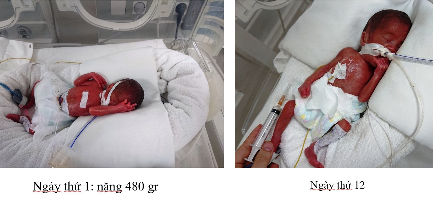 Bệnh nhi 10 tháng tuổi đã bị u nang ống mật chủ biến chứng - Ảnh 2. Bệnh nhi 10 tháng tuổi đã bị u nang ống mật chủ biến chứng - Ảnh 2.