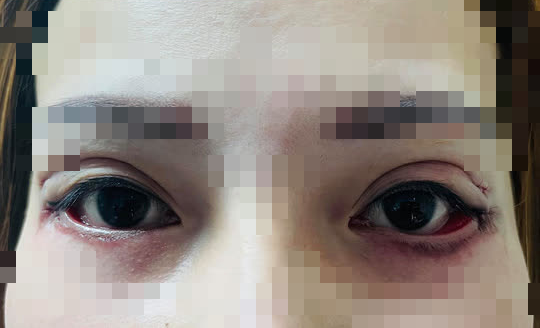 Cô gái suýt mù sau cắt mí mắt phải đến viện cầu cứu, chuyên gia liền đưa ra 2 lưu ý trước - 9 lưu ý sau cắt mí mắt để tránh tai biến lại đẹp bền tự nhiên - Ảnh 1.