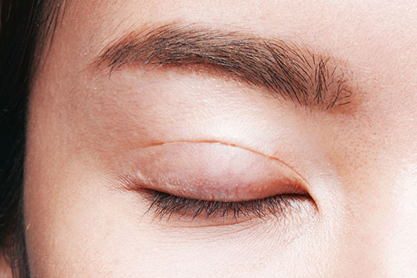 Cô gái suýt mù sau cắt mí mắt phải đến viện cầu cứu, chuyên gia liền đưa ra 2 lưu ý trước - 9 lưu ý sau cắt mí mắt để tránh tai biến lại đẹp bền tự nhiên - Ảnh 4.