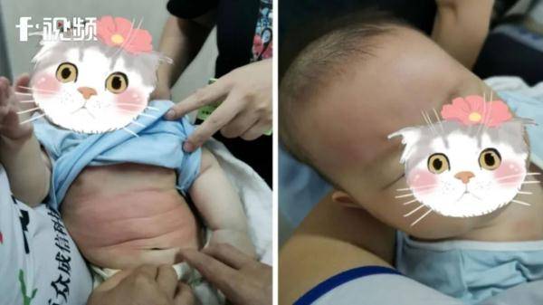 Tin vào bài thuốc hạ sốt của người nhà, bé trai 4 tháng tuổi bị nổi mẩn đỏ toàn thân - Ảnh 1.