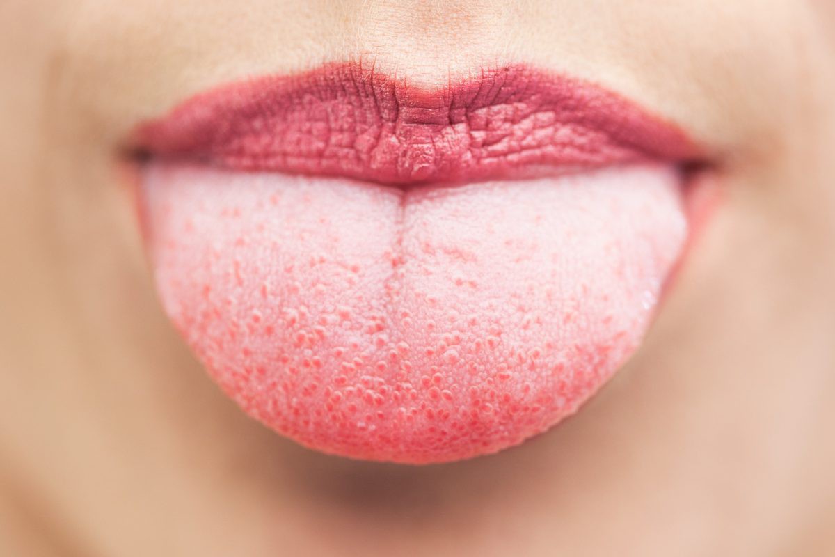 Nguyên nhân phổ biến khiến lưỡi chuyển sang màu trắng và cách ngăn ngừa tình trạng này - Ảnh 3.