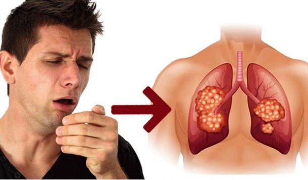 Thường xuyên xuất hiện 4 triệu chứng này thì có thể bạn đã bị üɳġ ʈɧư phổi rồi, nhiều người rất dễ nhầm lẫn và hay bỏ qua dấu hiệu 3 - Ảnh 2.