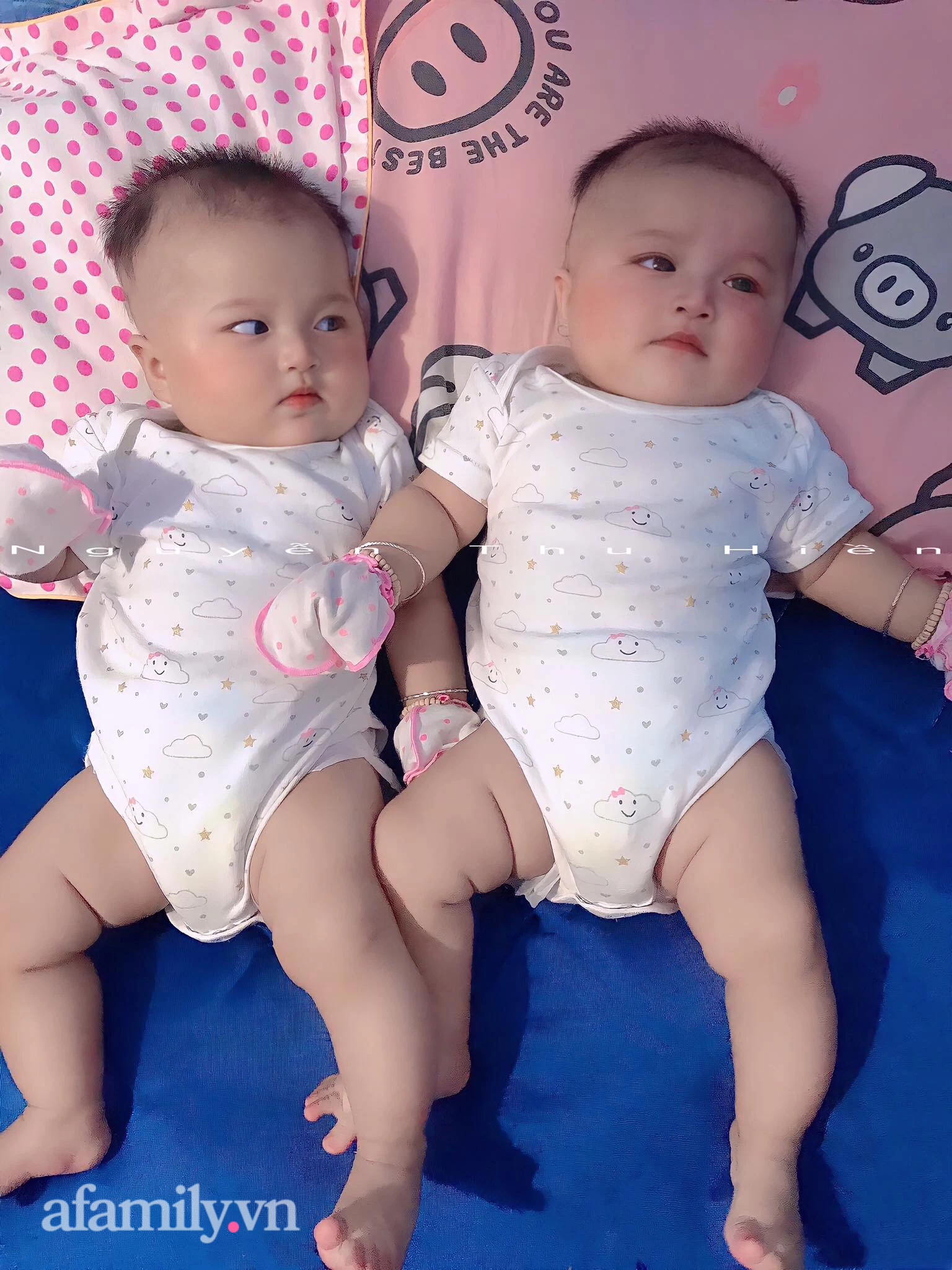 Hai bé gái sinh đôi chào đời với khuôn mặt như búp bê hiện tại thay đổi ra sao? - Ảnh 3.