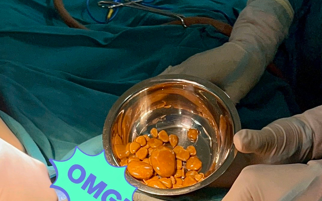 Sốc với lượng sỏi bàng quang 