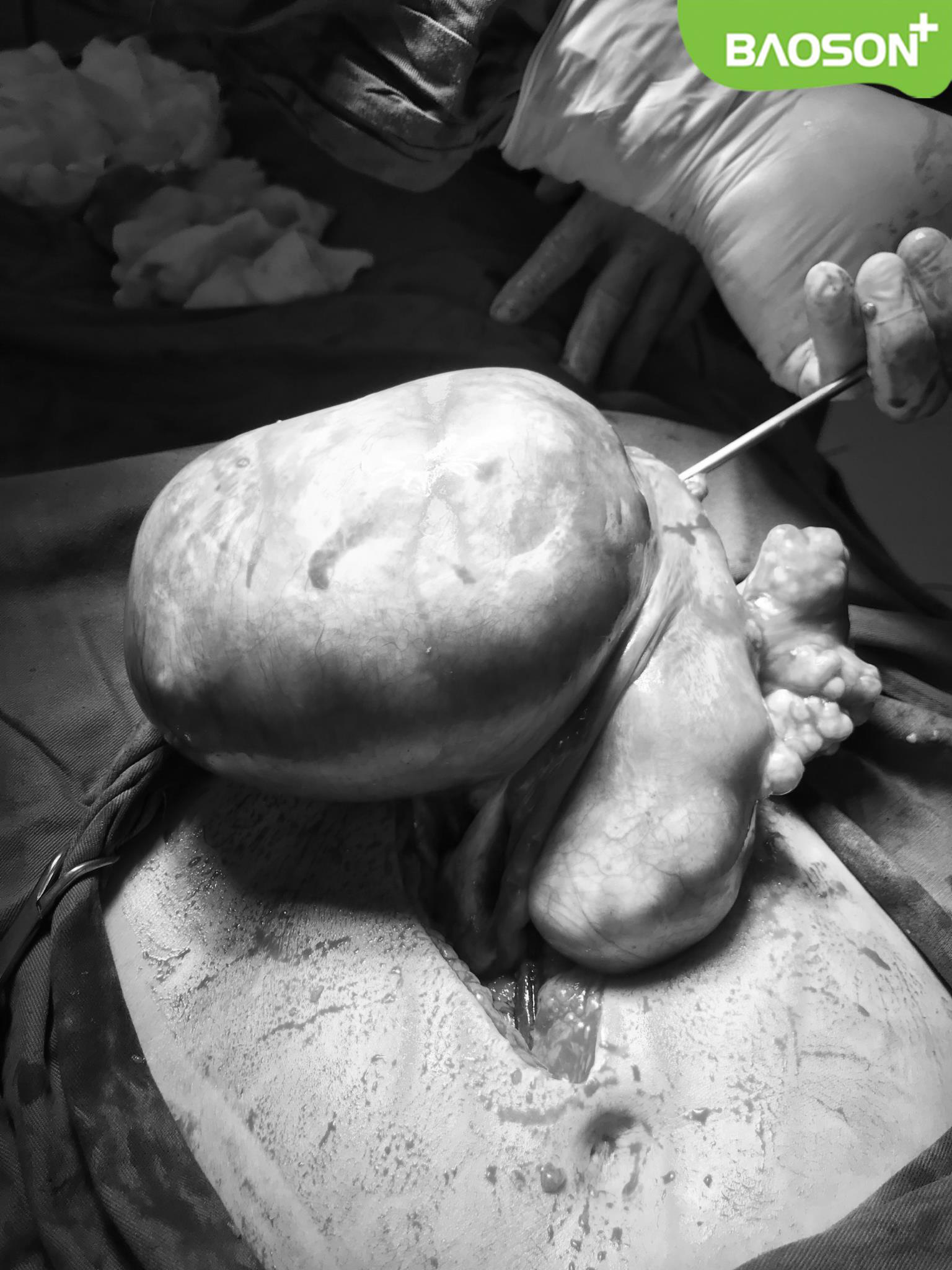 Cắt khối u xơ tử cung “khủng” 3kg, giải thoát nữ bệnh nhân 10 năm đeo bệnh - Ảnh 2.