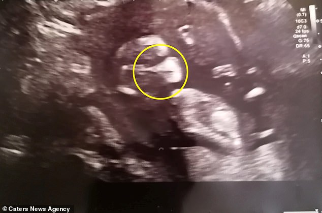 Siêu âm ở tuần 12 thấy hình ảnh thai nhi “đeo khẩu trang”, chỉ vài ngày sau bà mẹ nhận được tin mắc COVID-19 - Ảnh 1.