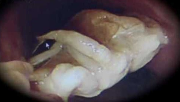 Người phụ nữ bất ngờ bị ngạt thở khi đang ăn mì, sau đó dị vật được lấy ra từ cơ thể cô đã khiến bác sĩ hoang mang tột độ - Ảnh 2.