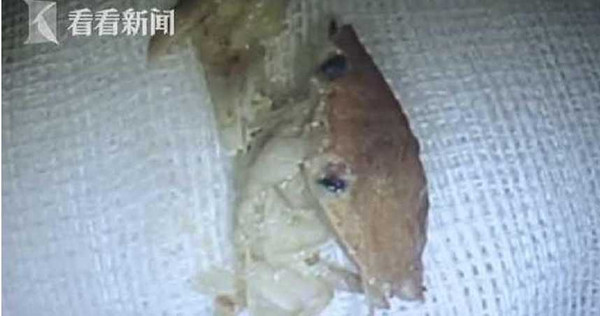 Người phụ nữ bất ngờ bị ngạt thở khi đang ăn mì, sau đó dị vật được lấy ra từ cơ thể cô đã khiến bác sĩ hoang mang tột độ - Ảnh 3.