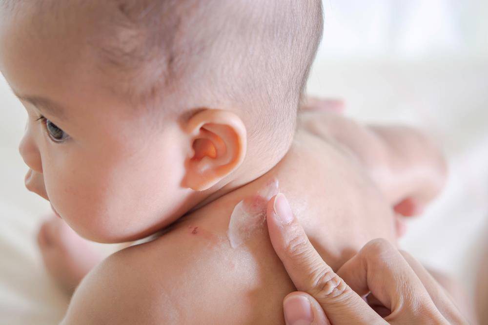 Ngăn ngừa, giảm nhẹ nhiễm trùng eczema ở trẻ - Ảnh 1.