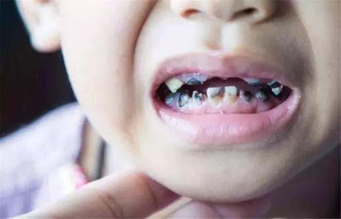 7 nguyên nhân gây sâu răng hàng đầu ở trẻ