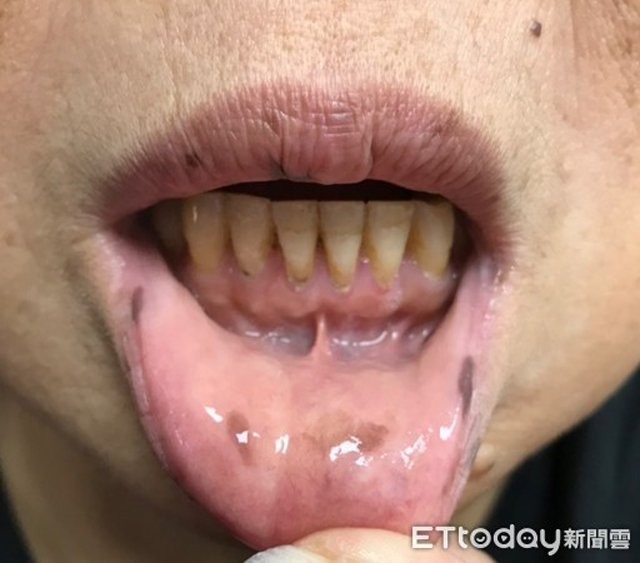 Xuất hiện nhiều đốm tàn nhang ở môi, họng và tay, người phụ nữ được chẩn đoán mắc bệnh ung thư - Ảnh 2.