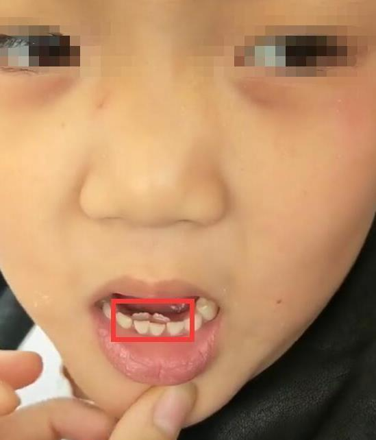 Bé gái 8 tuổi tự nhiên kêu đau răng, đi khám thì thấy răng mới đã ...