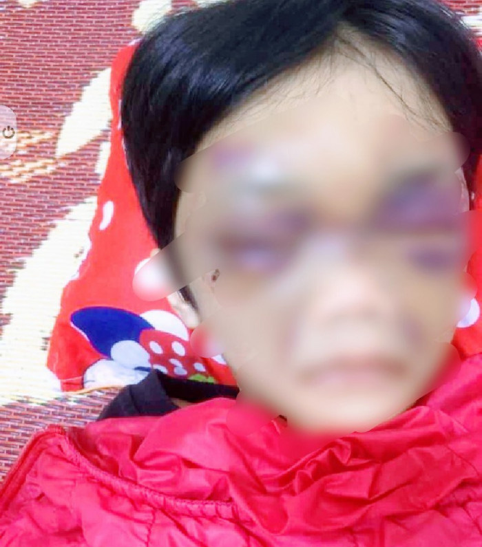 Mẹ đẻ bạo hành con gái 6 tuổi thâm tím mặt mày, nhốt trong phòng trọ - Ảnh 1. Mẹ đẻ bạo hành con gái 6 tuổi thâm tím mặt mày, nhốt trong phòng trọ - Ảnh 1.