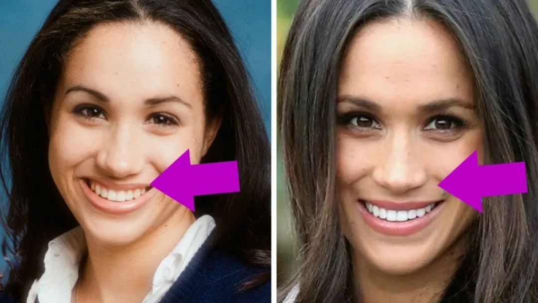 Meghan Markle bị lục lại ảnh cũ, nghi vấn thẩm mĩ nhan sắc rõ mồn một: Sống mũi &quot;giả trân&quot;  - Ảnh 4.