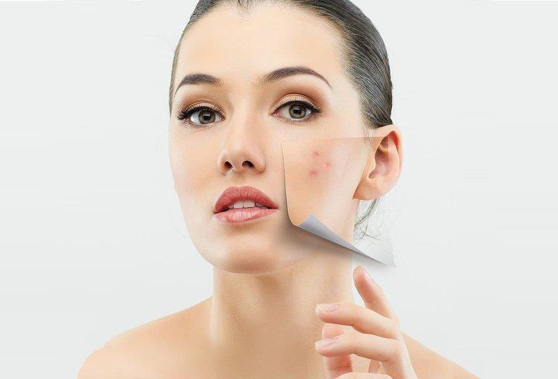 Da mụn c&oacute; n&ecirc;n d&ugrave;ng kem chống nắng? - Ảnh 1.